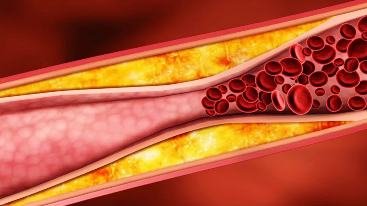  Hiperlipidemia desde la perspectiva Ayurvédica.